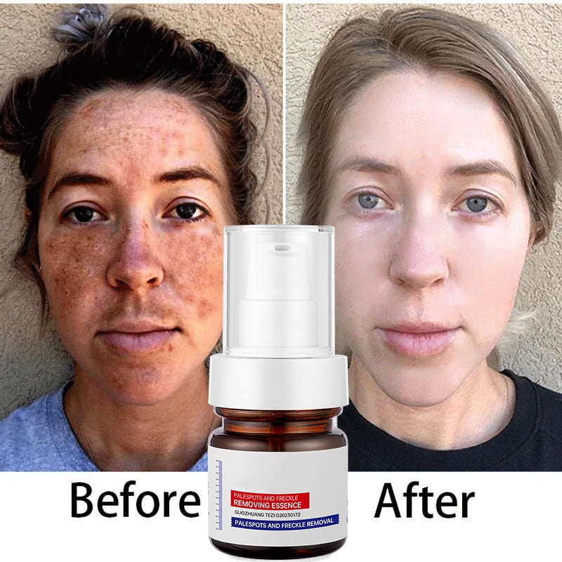 ⚡5-second brightening rescue: Dark spots disappear, blemishes fade, and skin becomes radiant! Vitamin C Whitening Freckles