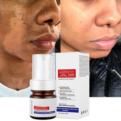 ⚡5-second brightening rescue: Dark spots disappear, blemishes fade, and skin becomes radiant! Vitamin C Whitening Freckles
